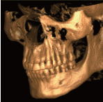西条市　歯科　東予歯科　CT画像解析2