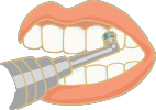PMTCイメージ　プロによる歯のクリーニング