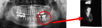 西条市　歯科　東予歯科　CT解析画像3